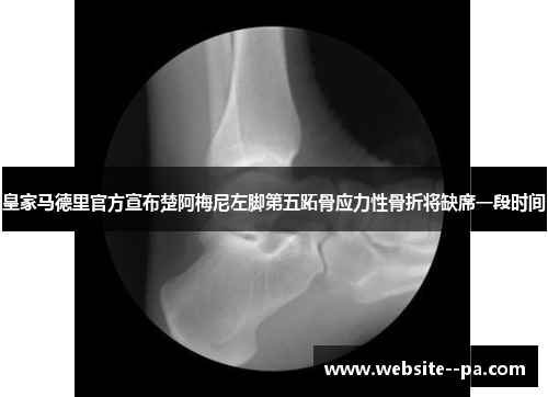 皇家马德里官方宣布楚阿梅尼左脚第五跖骨应力性骨折将缺席一段时间